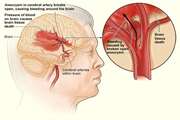 Evaluation of angiographic findings in spontaneous aneurysmal subarachnoid hemorrhage patients 